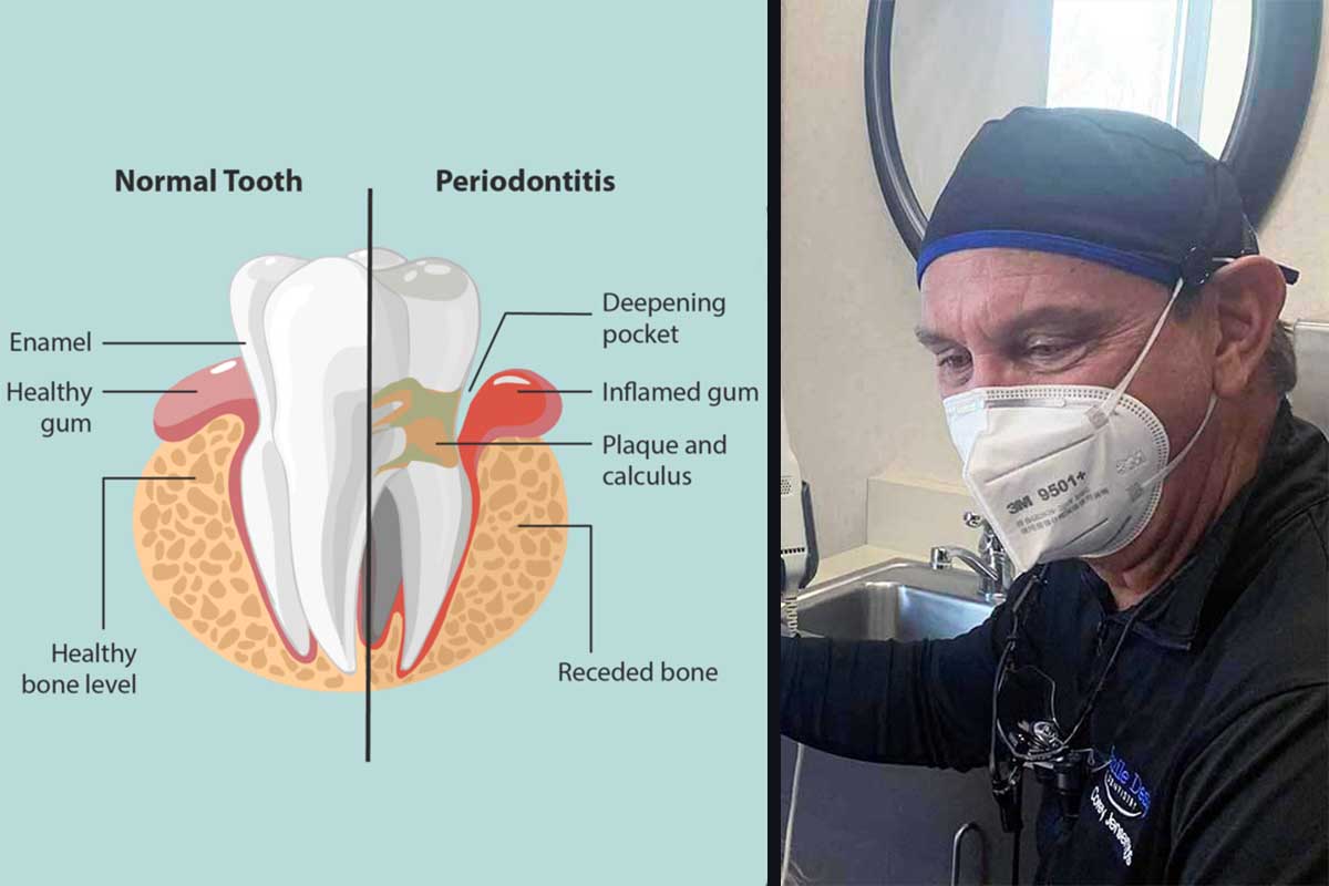 What Is Periodontal Disease Do I Have Perio Scaling 